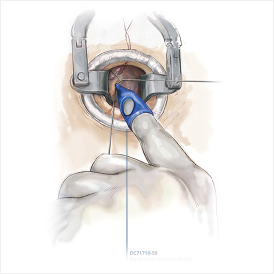 フィンガーノットプッシャーを使用した手術
