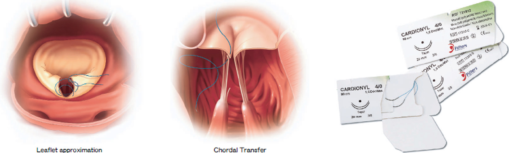 CARDIONYL®